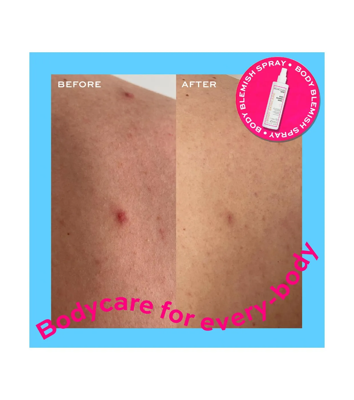 Revolution Skincare - *Body Skincare* - Spray corporal anti-imperfecciones